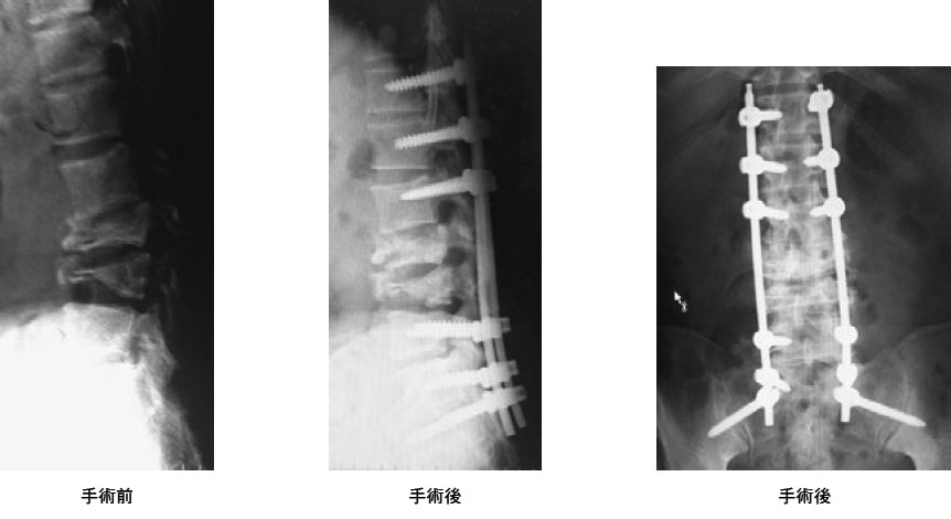 転移性脊椎腫瘍に対する低侵襲脊椎固定術