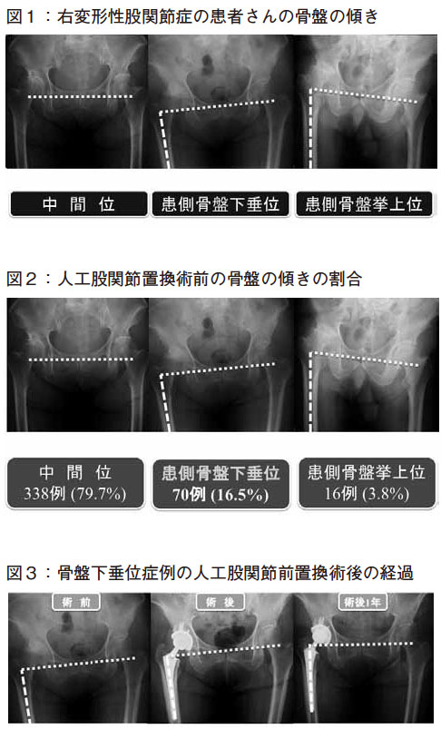 骨盤の傾きと脚長差の感じ方