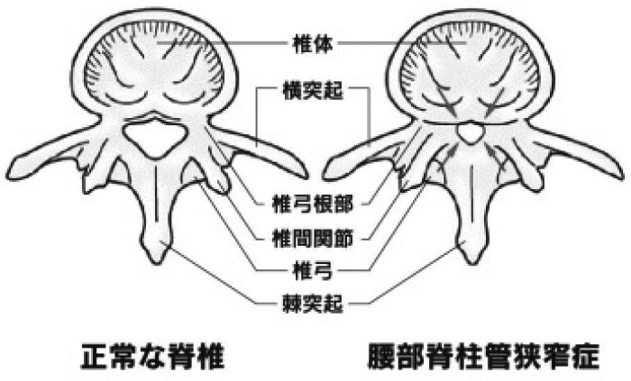 腰部脊柱管狭窄症