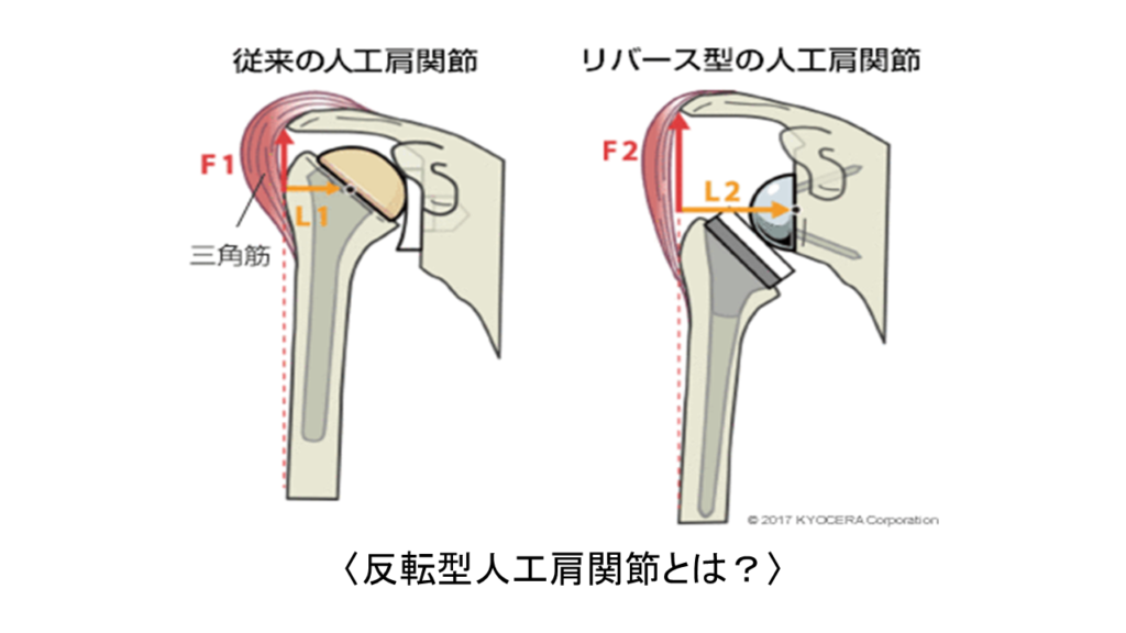 反転型人工肩関節（リバースショルダー）の現在地〜 | 佐賀大学医学部